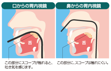 内視鏡の口からと鼻からの違い